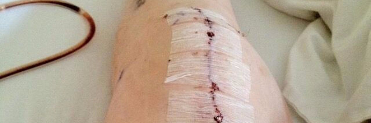 Holding Onto Hope With Lupus, Chronic Pain seven-inch scar down a woman's knee
