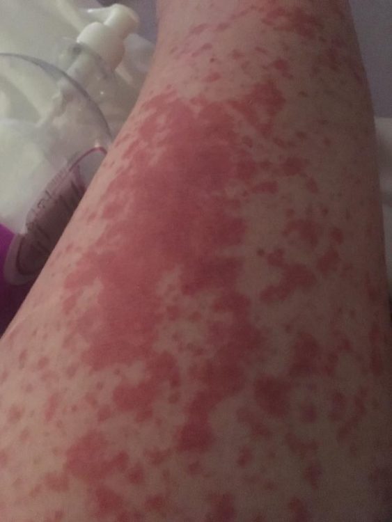 woman with red rash on her arm