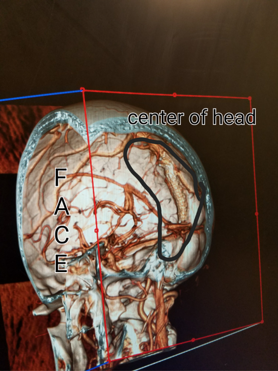IMAGE-3d recreation from recent CTV scan. Stent is circled, face was cut off digitally.
