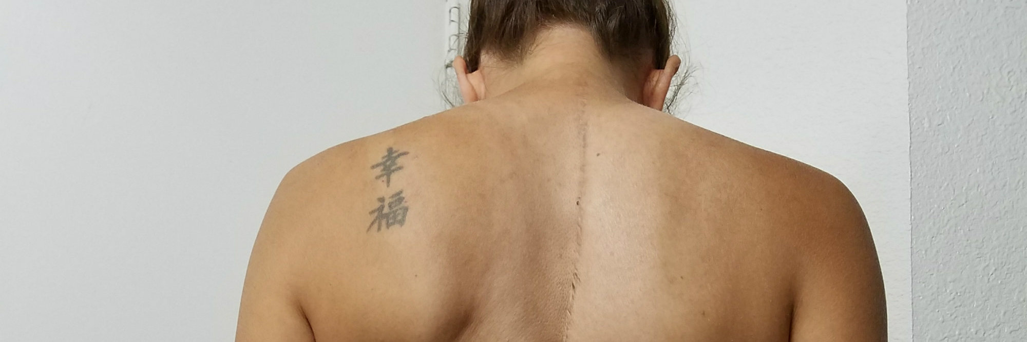 Talking About Scoliosis 'Hump' to Raise Awareness woman shows the hump on her back from scoliosis