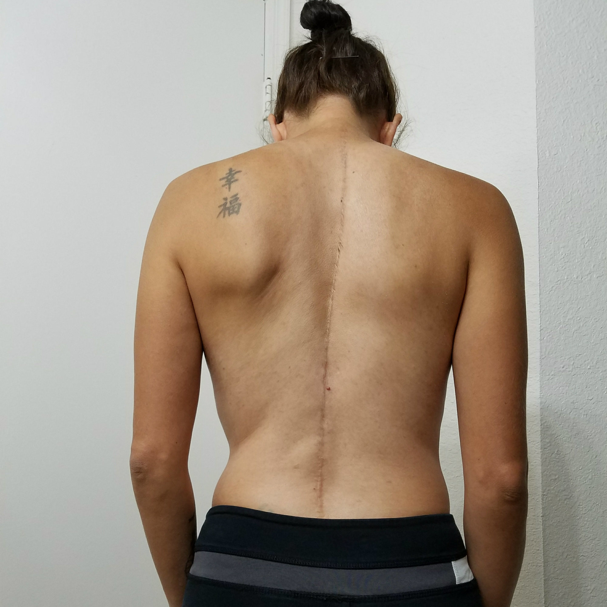 woman shows the hump on her back from scoliosis