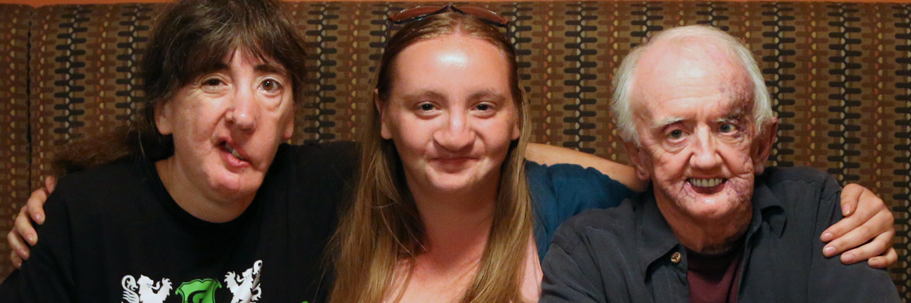 Finding My 'Tribe' at a Camp for People With Facial Differences The author with her friends Pauline and David