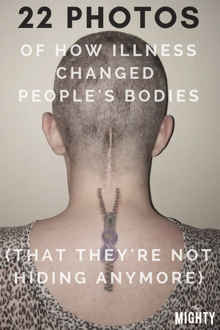 22 Photos of How Illness Changed People's Bodies (That They're Not Hiding Anymore)