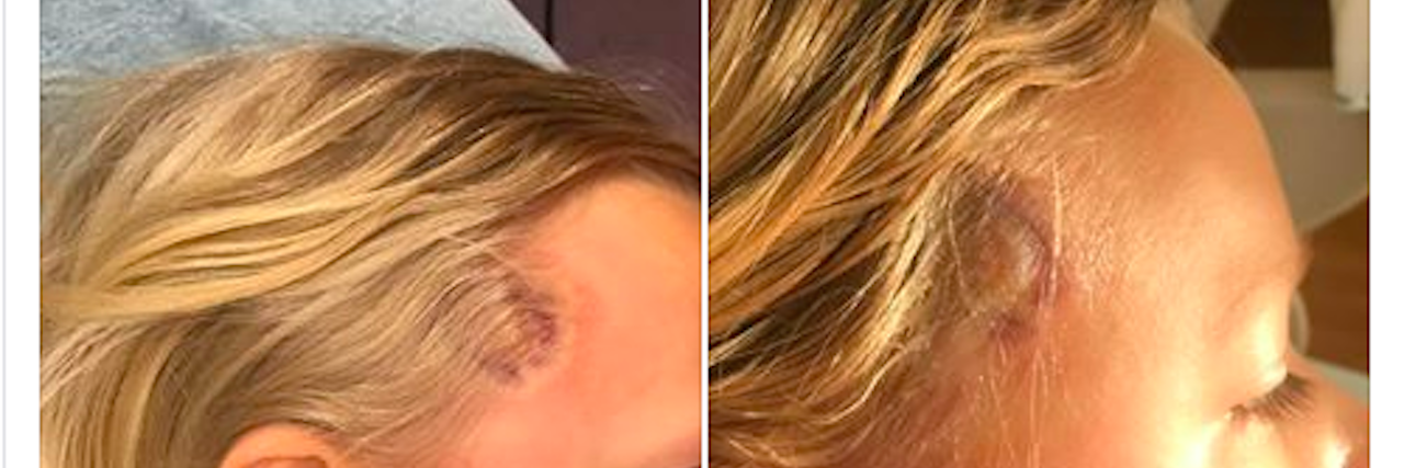 Mom's Facebook Post Shares Daughter's Lyme Disease Symptoms viral lyme photo