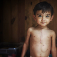 little boy with scar from heart surgery
