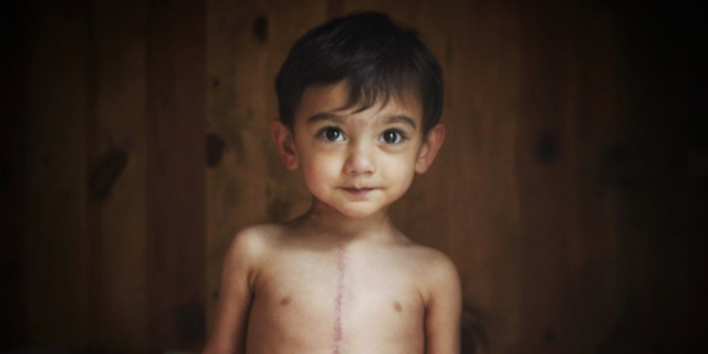 little boy with scar from heart surgery