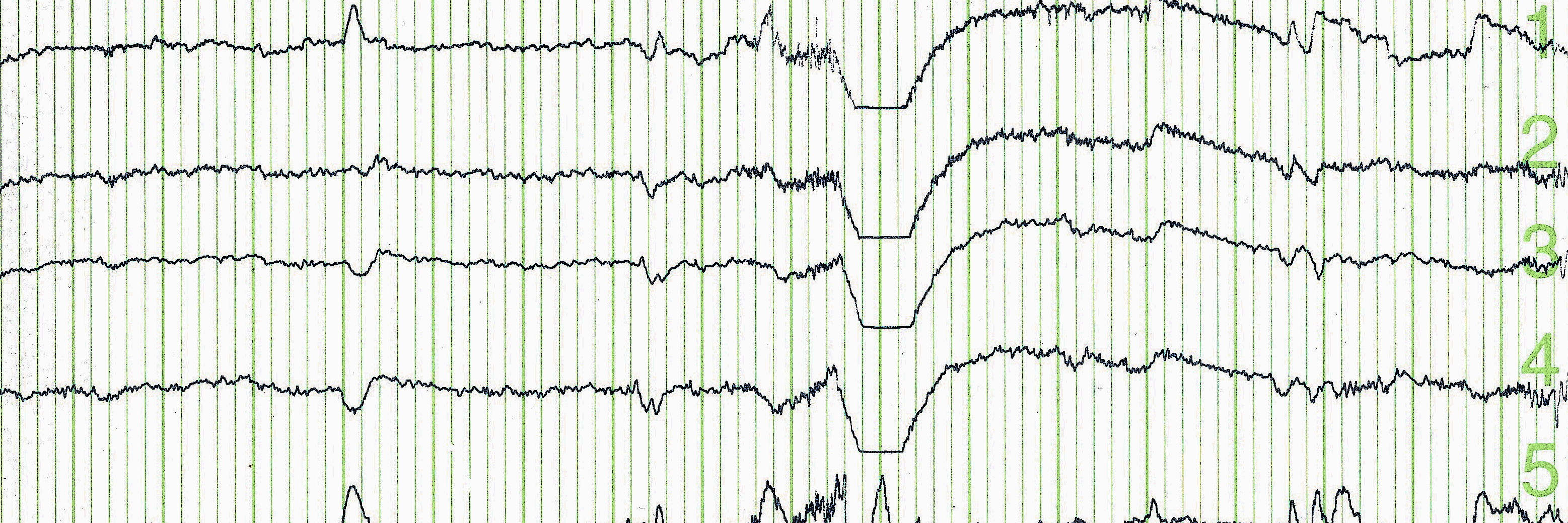 EEG brain wave.