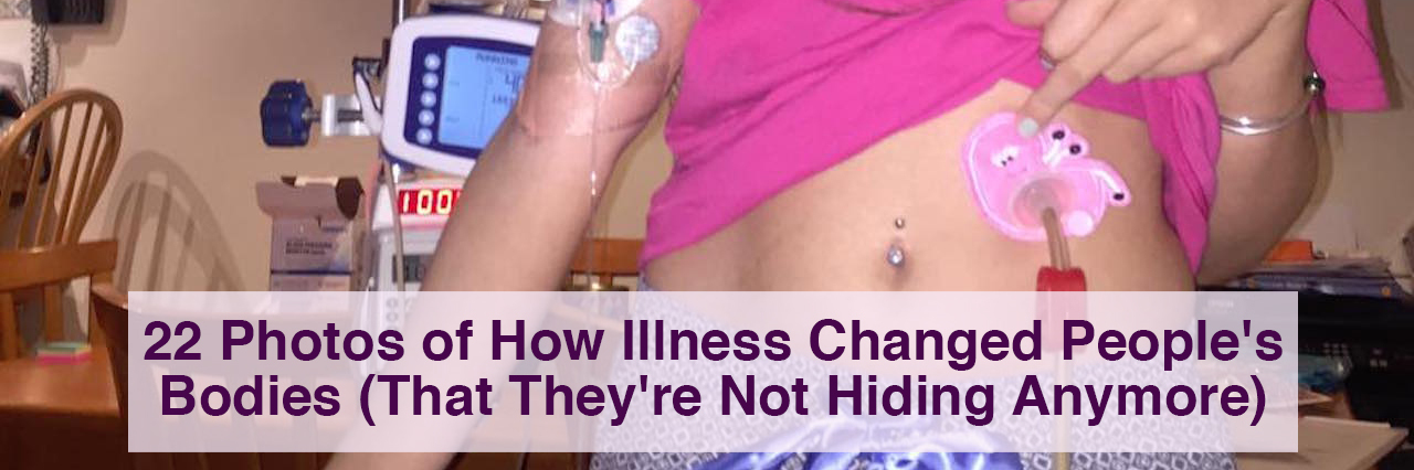 22 Photos of How Chronic Illness Can Change Your Body 22 photos of how illness changed people's bodies (that they're not hiding anymore)