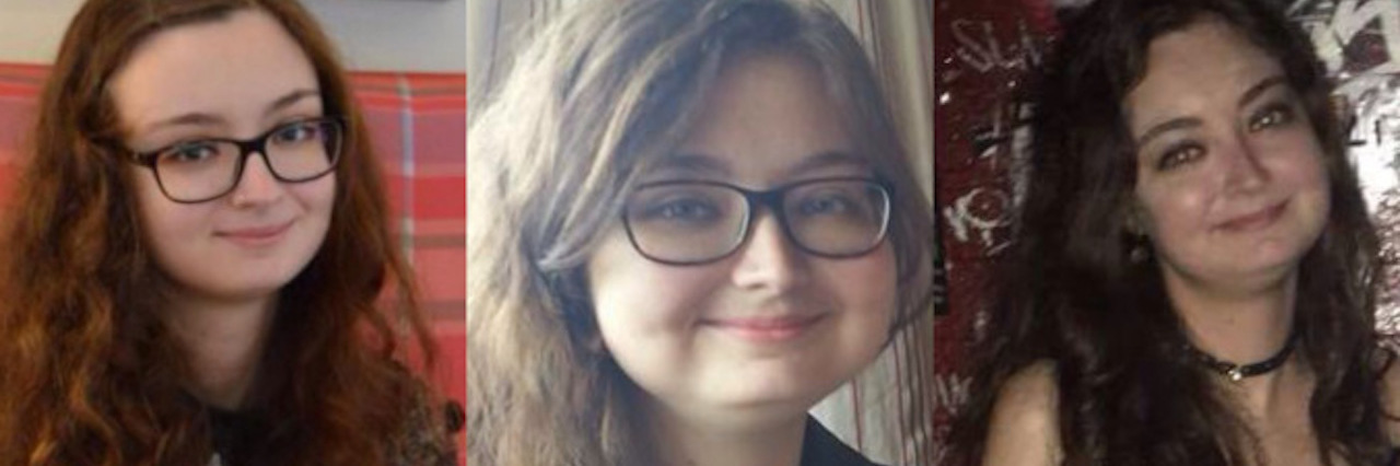 Getting a 'Moon Face' on Prednisolone for Lupus three images of a woman's face over three years