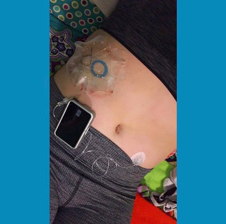 woman with diabetes tattoos on her stomach