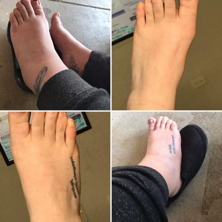 four photos comparing a woman's foot when it's 'normal' and when it's swollen