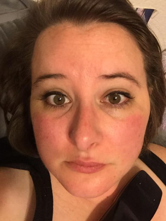 woman whose face is red during a pain flare