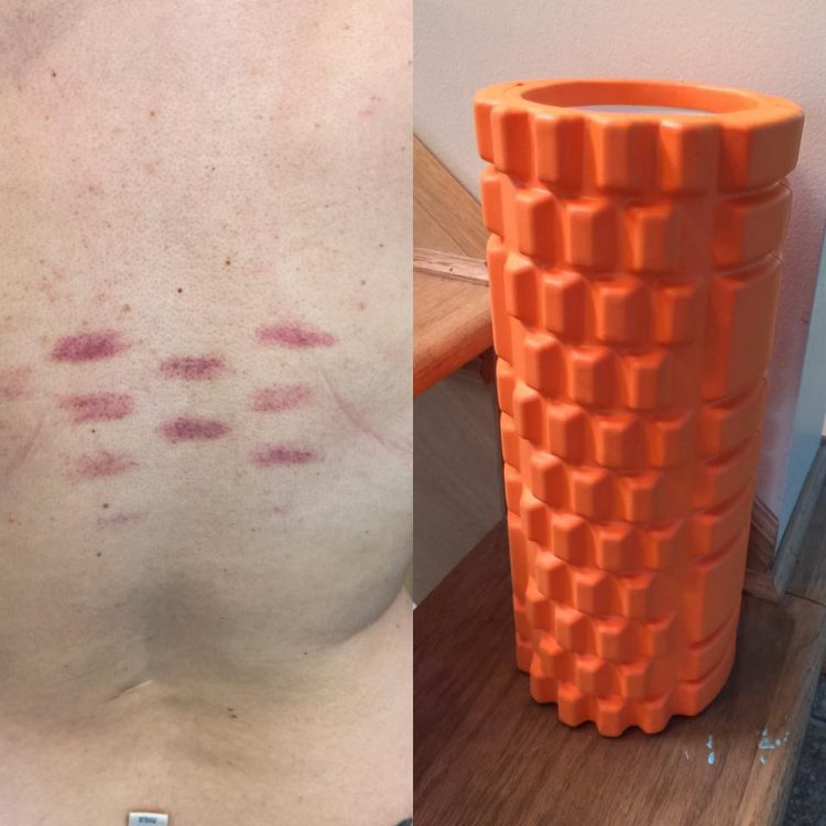 bruises on a woman's back from a foam roller