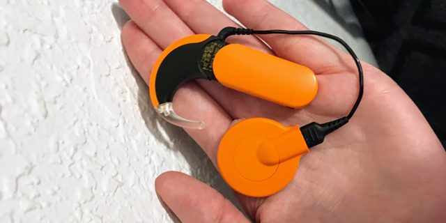 What It's Like to Get a Cochlear Implant as a Young Adult Chloe's cochlear implant processor.
