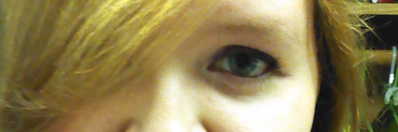 Hiding My Orbital Myositis Behind Hair or Makeup woman with her hair styled to cover one of her eyes