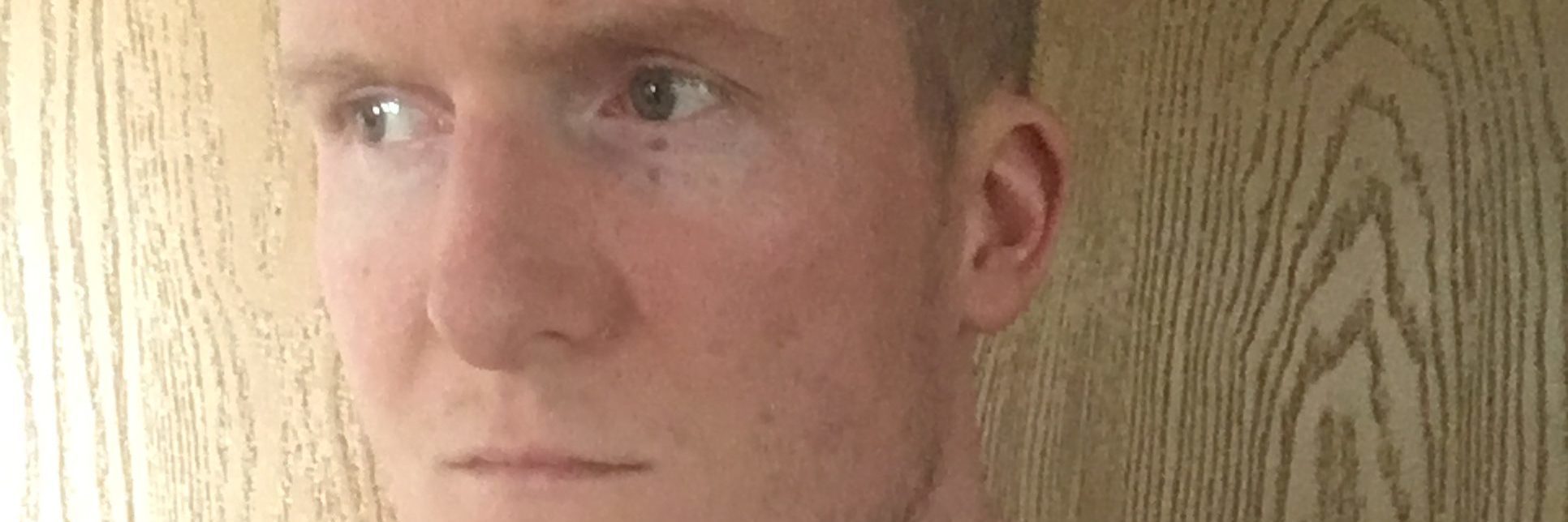 Cardiomyopathy: Keeping My Shirt On During Summer to Cover My Scar photo of a man with a scar on his chest