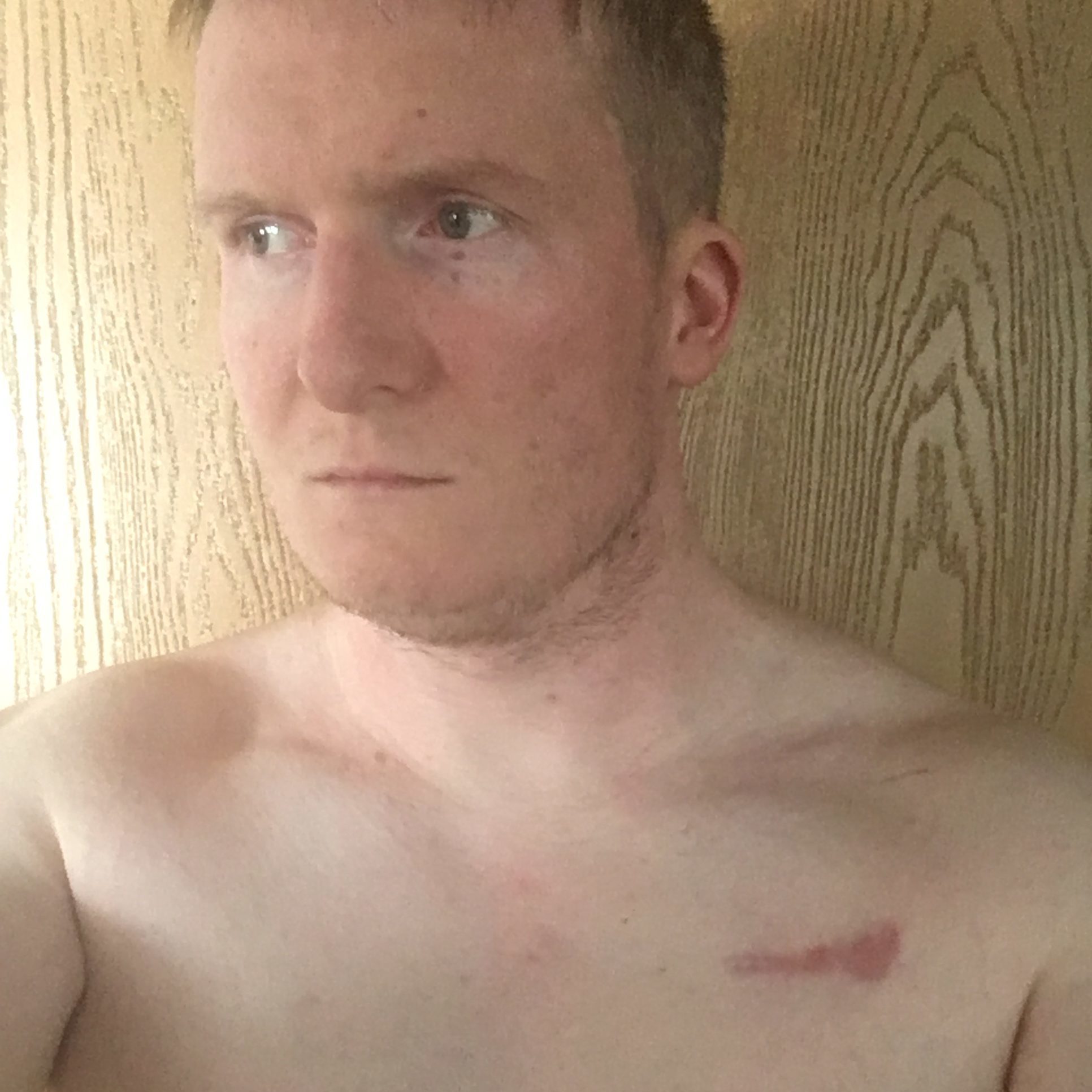 photo of a man with a scar on his chest