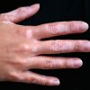 Hand with vitiligo