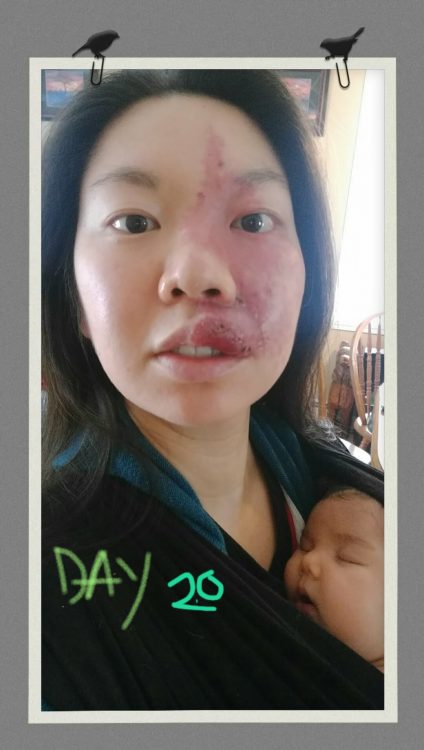 A woman with a port-wine stain birthmark on her face, holding a baby, while healing from surgery.