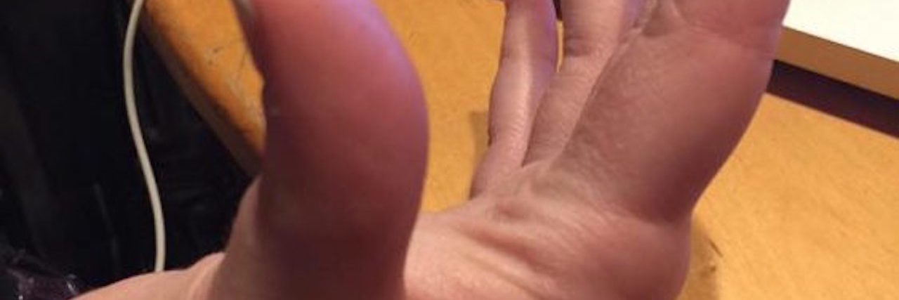 Why the Reality of Disability, Ehlers-Danlos Isn't Always 'Inspiring'