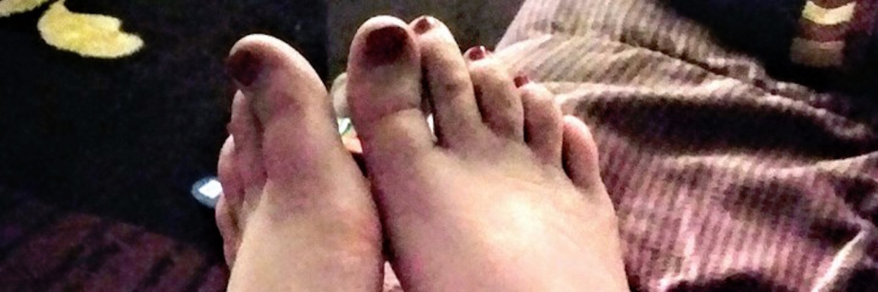 Coping With Pain in Feet, a New Symptom of Fibromyalgia