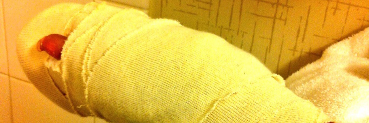 woman's entire hand and wrist wrapped heavily with bandages