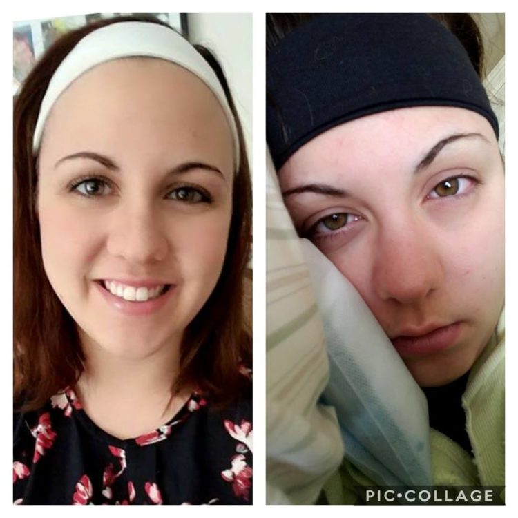 side by side photos of a woman dressed up with makeup on, and lying in bed with a migraine