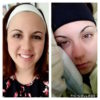 photos of woman with and without migraine