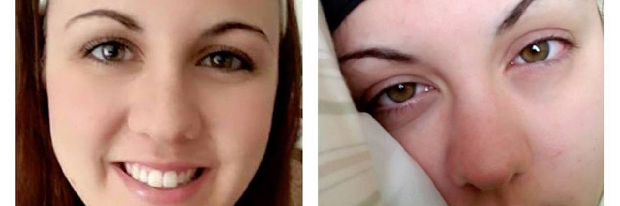 20 Photos That Show What Migraine Really Looks Like photos of woman with and without migraine