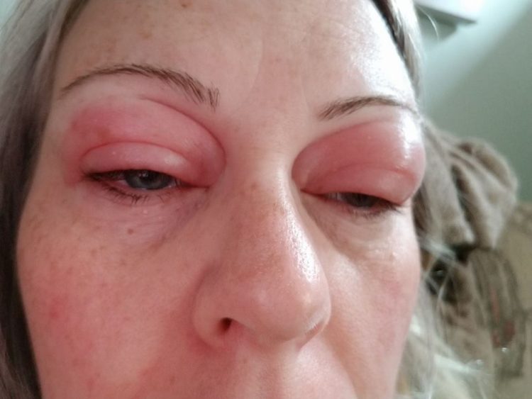 woman with red and swollen eyelids