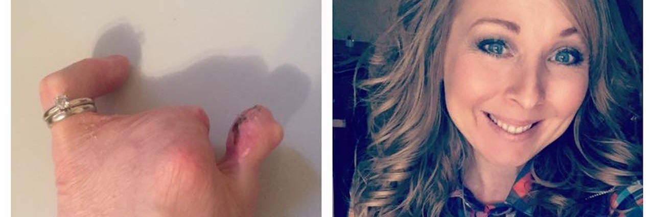 Amniotic Band Syndrome: Surgery to Repair Scarred Hands, Get a Thumb collage of photos of woman before and after getting surgery to give her a thumb