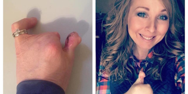 collage of photos of woman before and after getting surgery to give her a thumb