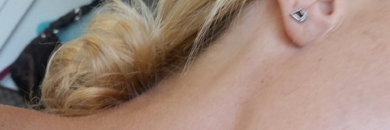 Enlarged Lymph Node in Neck From Rheumatoid Arthritis Medication woman with enlarged lymph node in her neck