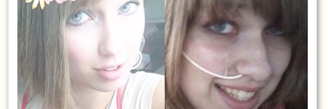 Being Asked What You're Doing With Your Life With Chronic Illness photo of a woman smiling next to photo of her with a feeding tube