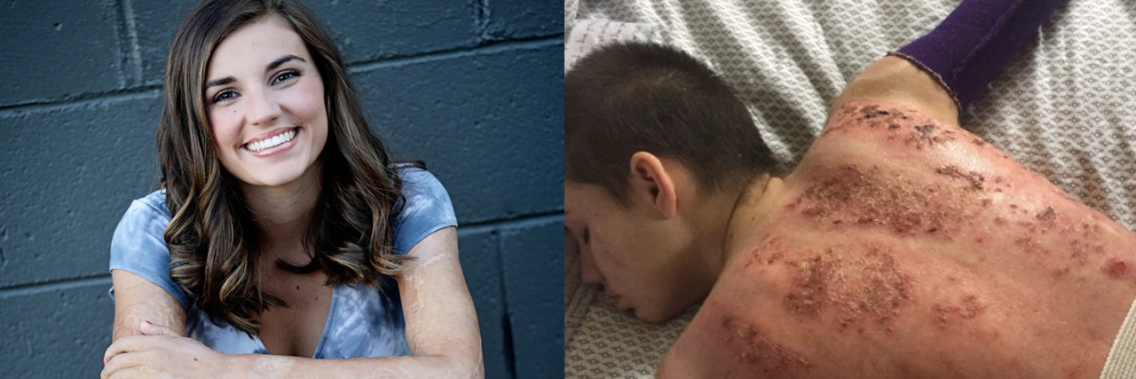 Talking To Your Partner About Scars and Skin Grafts woman with long brown hair sitting, you can see burn marks on her arms and legs. Next photo is a woman lying on her back. Her head is shaved and she has burns all over her back.