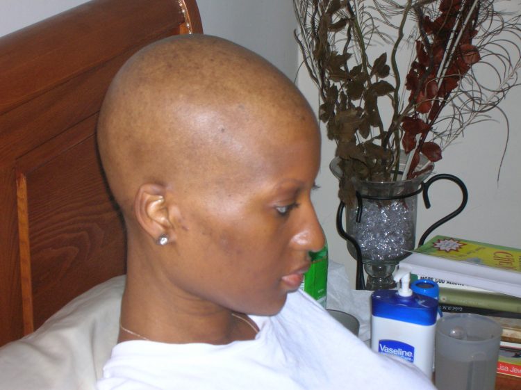 woman with breast cancer side shot of head