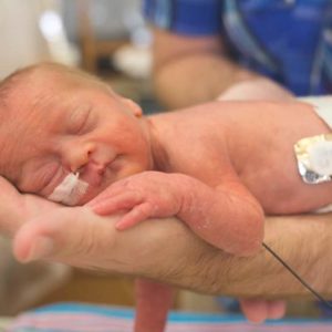 Baby with down syndrome with ntube and sleeping on dad's arms.