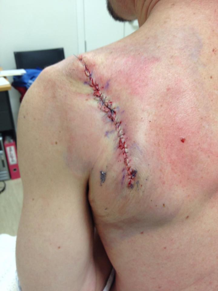 cancer patient scar after surgery