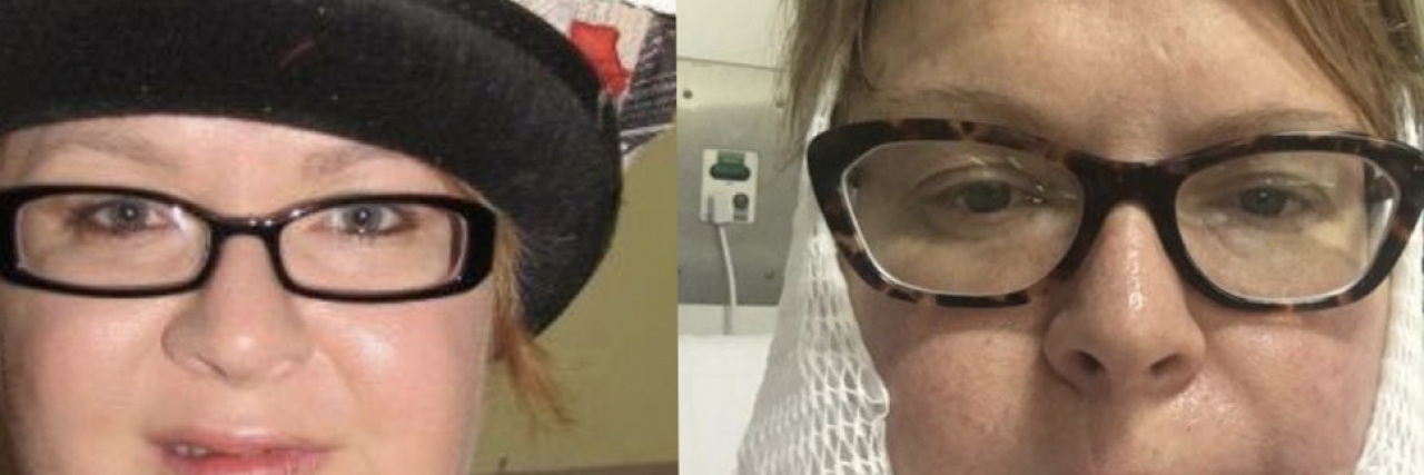 After Ignoring a Cancerous Lump for 11 Years, Woman Shares Photos to Help Others Side by Side photos of Dominy before and after skin cancer.