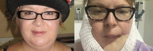 Side by Side photos of Dominy before and after skin cancer.
