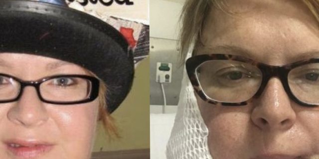 Side by Side photos of Dominy before and after skin cancer.