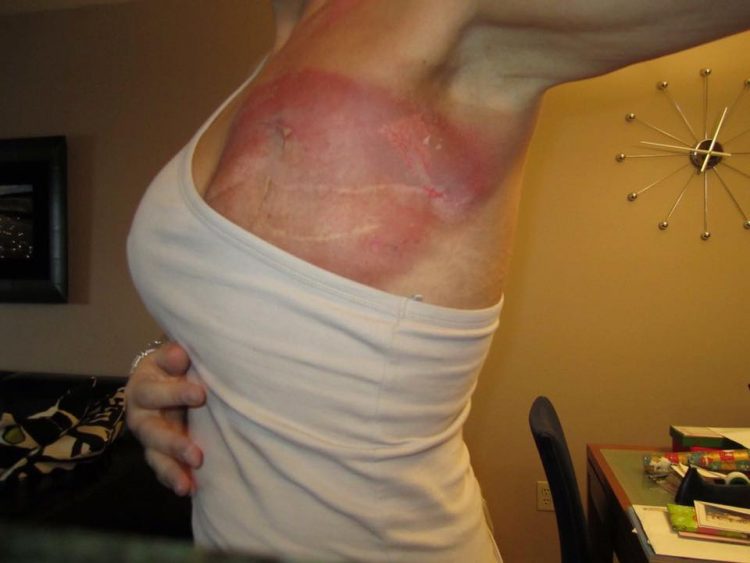 woman with breast cancer mastectomy scars