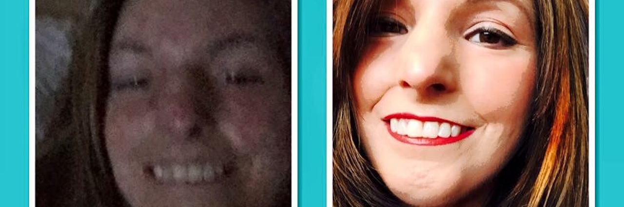 Trying to Get Approved for Stem Cell Transplant for Scleroderma