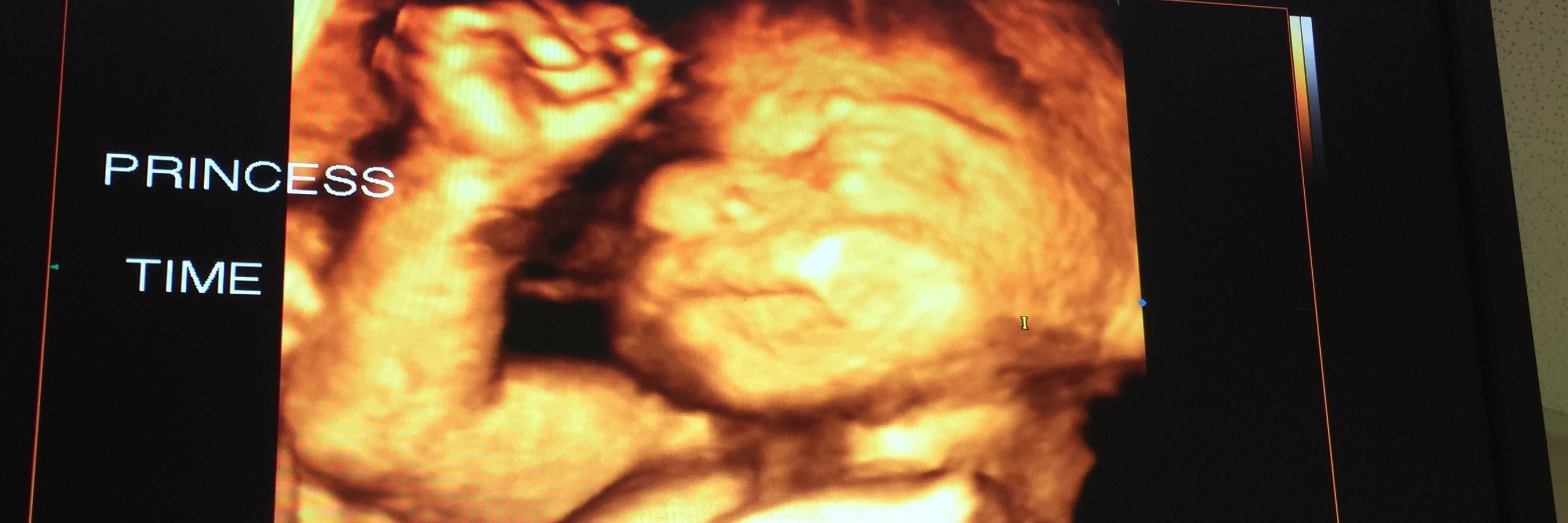 My Unborn Baby Was Just Diagnosed With a Congenital Heart Disease
