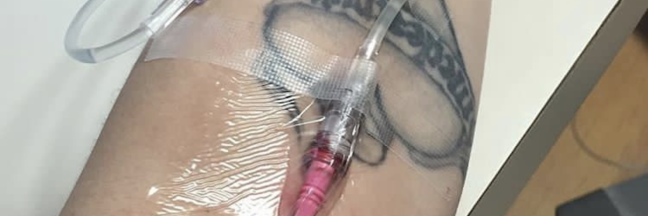 Behcet's Disease: Why You Should Keep Fighting Against Chronic Illness woman receiving an IV infusion in her arm