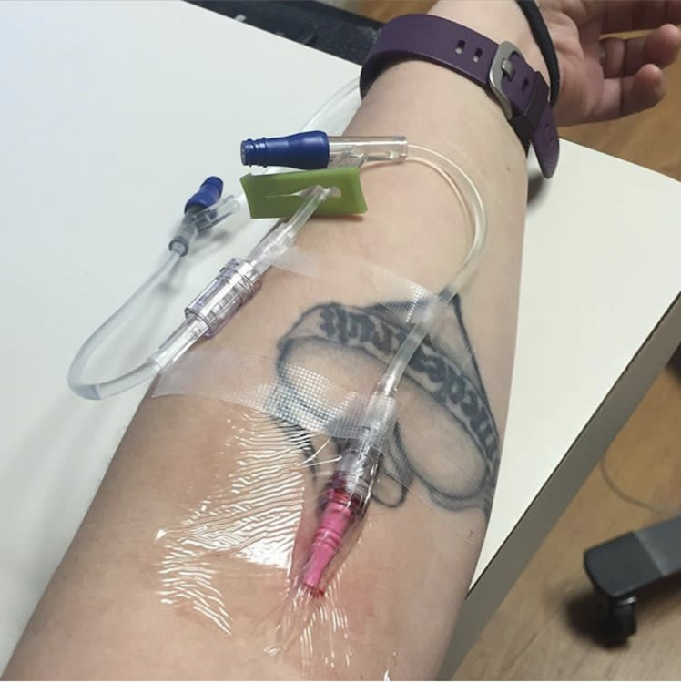 woman receiving an IV infusion in her arm