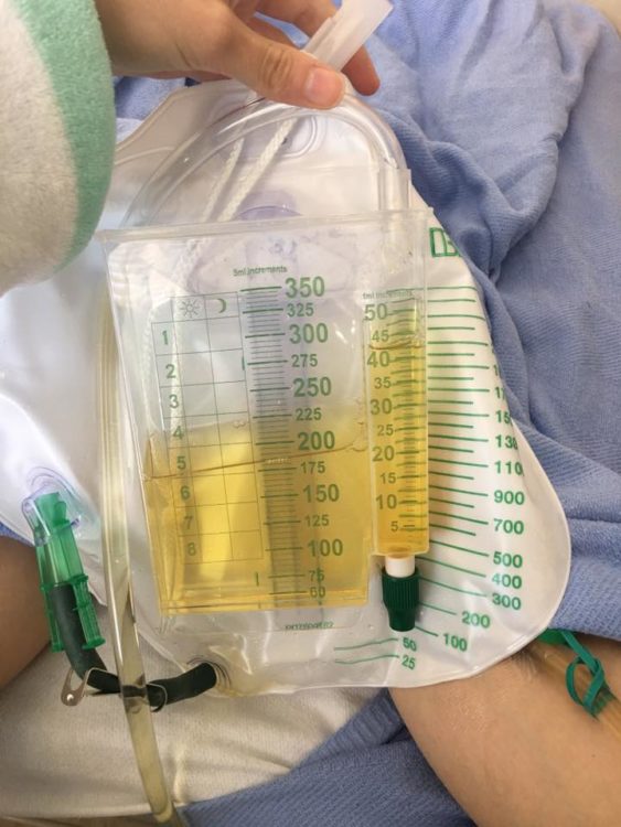 urine in a bag from foley catheter