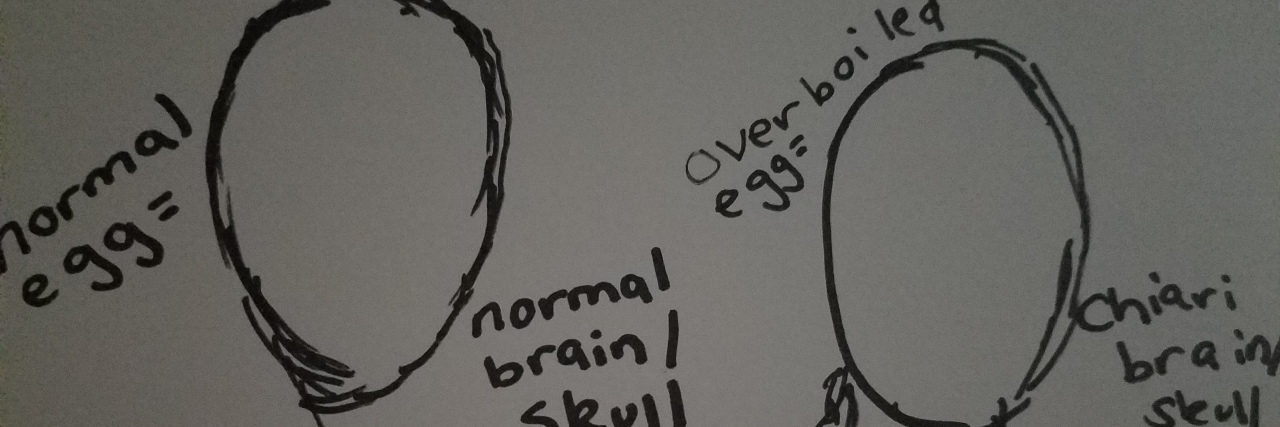 Arnold-Chiari Malformation: Sharing My Story to Raise Awareness drawing of eggs comparing normal brain skulls to brain skulls with chiari malformation
