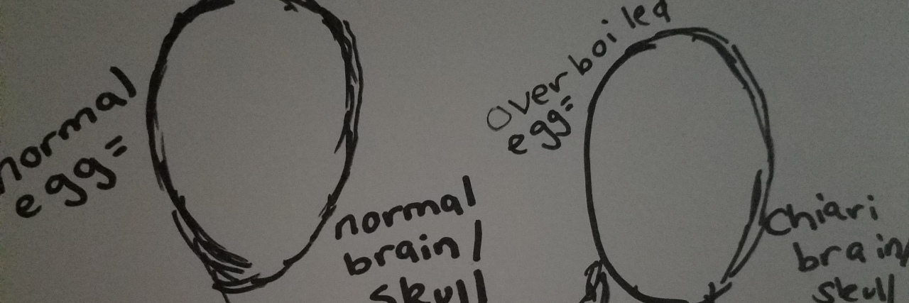drawing of eggs comparing normal brain skulls to brain skulls with chiari malformation