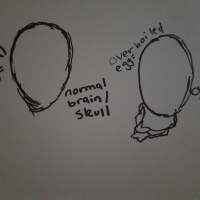 drawing of eggs comparing normal brain skulls to brain skulls with chiari malformation